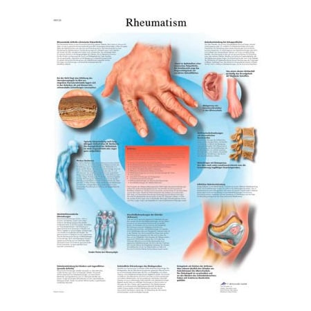 Fabrication Enterprises 3B Anatomical Chart - Rheumatic Diseases, Laminated 12-4618L